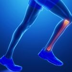 Periostitis Tibial