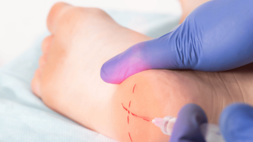 como-curar-la-fascitis-plantar
